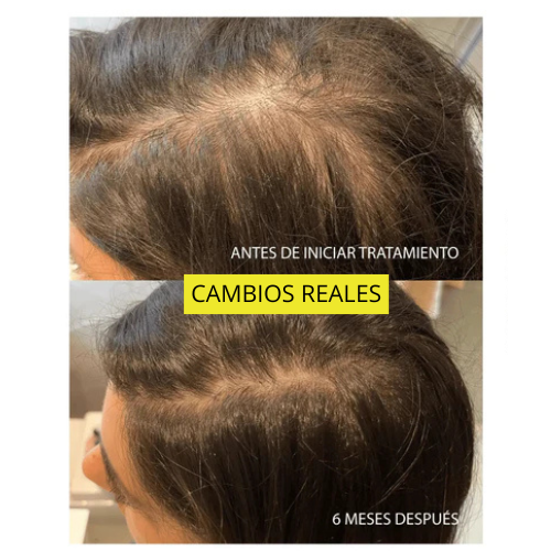 ReviMen™ – Aceite anticaída.